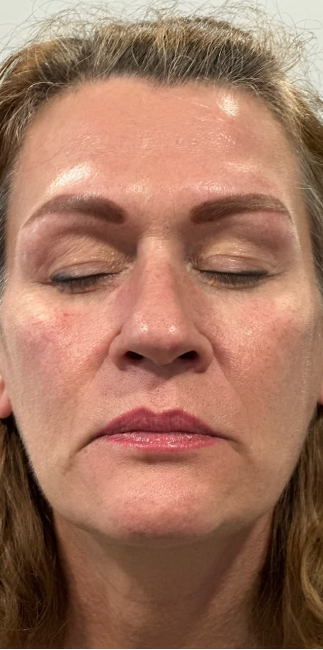 Skin Rejuvenation after