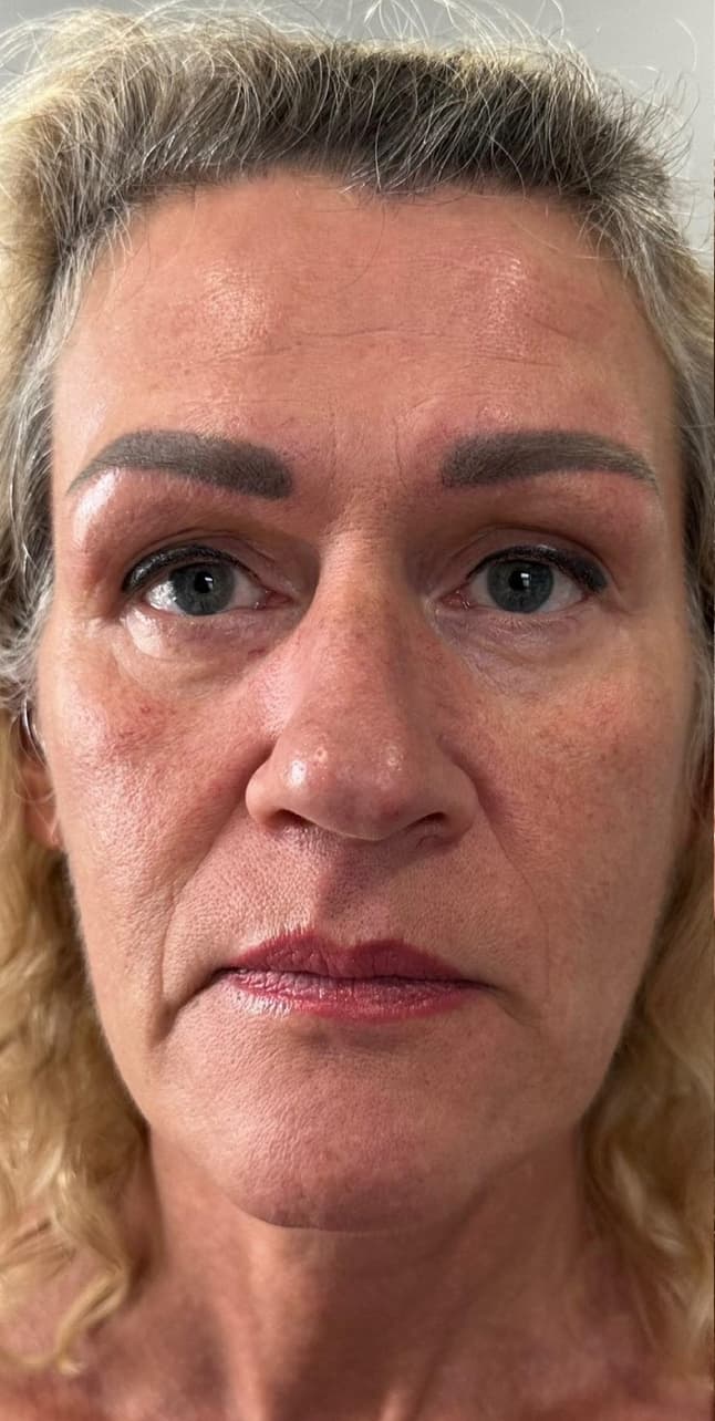 Skin Rejuvenation before