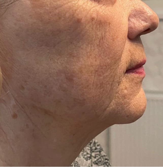 Injectable Treatments after