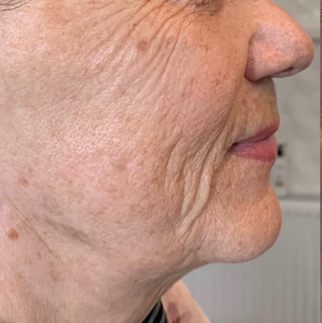 Injectable Treatments before